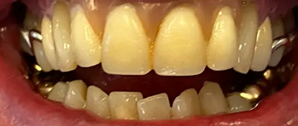  before and after images of dental