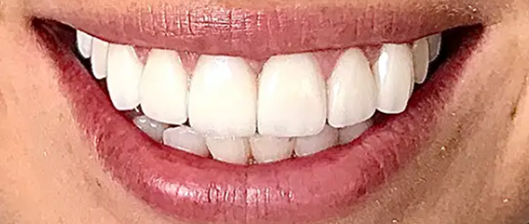  before and after images of dental