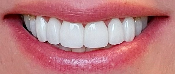 before and after images of dental