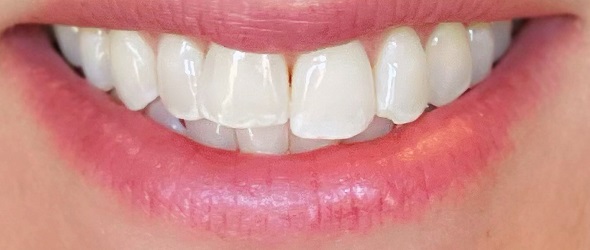  before and after images of dental